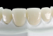 Denture e.max lithium veneer false fixed teeth of disilicate porcelain restoration artificial tooth realistic aesthetic