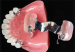 Denture e.max lithium veneer false fixed teeth of disilicate porcelain restoration artificial tooth realistic aesthetic