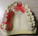 Denture e.max lithium veneer false fixed teeth of disilicate porcelain restoration artificial tooth realistic aesthetic