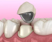 All Ceramics Crown and Bridge | Zirconia-Layered