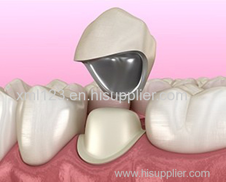 Steel Removable Dentures  3D print 3d printed partial dentures
