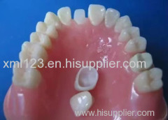 Steel Removable Dentures 3D print 3d printed partial dentures