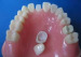 Steel Removable Dentures 3D print 3d printed partial dentures