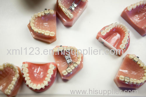 Dental lab Zirconia porcelain denture