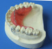 3d Printing Porcelain False Teeth Dental 3d Print