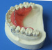 Dental lab Zirconia porcelain denture