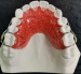 Denture Steel Partial Flexible Removable Teeth Porcelain Dental Crown