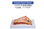 Disease Breast Model