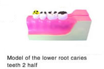 Model of the Lower Root Caries Teeth 2 Half