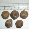 Gallstone