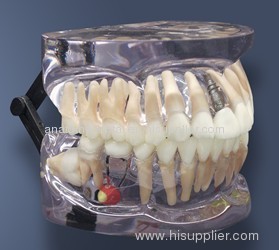 Dental Implants Bridge Pathologies Model