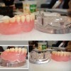 Dental 2 Implants Locator Lower Arch Model