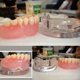 Dental 2 Implants Locator Lower Arch Model