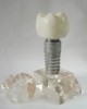 6 times Dental Implant model