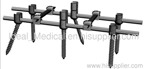 Spinal Internal Fixator Type3