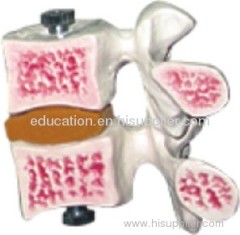 Model of Osteoporosis