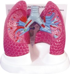 Lung Model with Bronchopulmonary Pathology