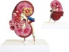 Dissection Model of Kidney with Cyst