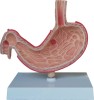 Dissection Model of Disessed Stomach