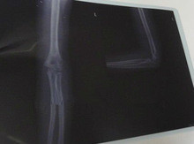 KND-F type 8*10 fuji medical x-ray film
