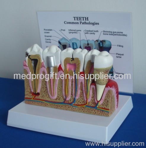 teeth commom pathologies model,dentistry model,odontology model,dentistry education model