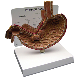 Human Stomach Cancer Model for pharmaceutical promotion