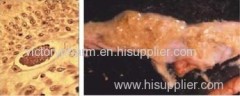 Coccidiosis in Chicken(poultry medicine)