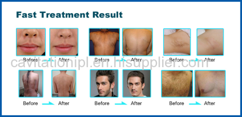 2014 Professional SHR IPL for hair removal