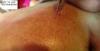 epilator ipl hair removal and spider vein removal machine, China IPL hair removal machine