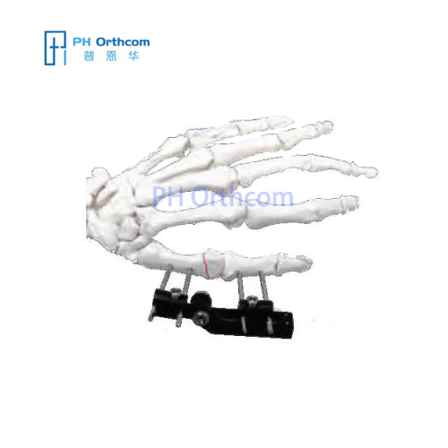 Orthopedic Instrument Trauma Tibial External Fixator System for Tibia  Fracture - China Synth External Fixation, External Fixator