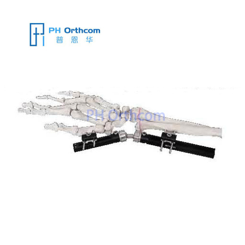 Orthopedic Instrument Trauma Tibial External Fixator System for Tibia  Fracture - China Synth External Fixation, External Fixator