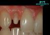 FDA Ceramic Dental Crowns Restoration Good Biocompatibility
