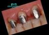 Precious Dental PFM Crown Palladium Silver Dental Post and Core