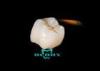 Ceramic Dental Crowns Lava Zirconia Excellent and Super Strength