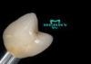 Lava Zirconia Tooth Crown Excellent and Super Strength Easy Clean