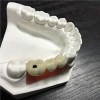 Implant Crown And Bridge