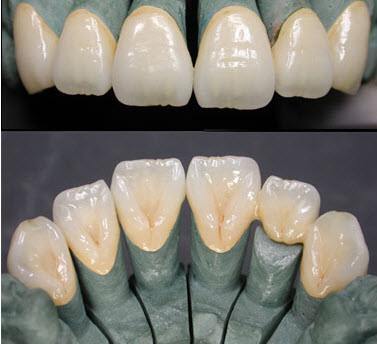 implant porcelain teeth dental implant porcelain