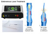 Varicose Veins Laser Treatment / Laser Ablation Varicose Veins