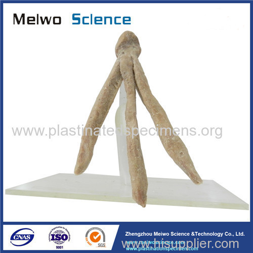 Human corpus cavernosum penis plastination