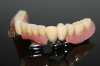Dental telescope denture & telesopic crown & dental prosthesis