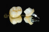 Dental implant abutment & implant crown & implant prosthesis & Intergrate Abutment Crown