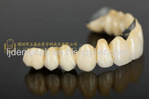 Dental crown porcelain fused meta & PFM crown & bridge & VMK & dental prosthesis