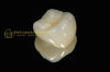 Dental crown 3M Lava zirconia & dental teeth & dental prosthesis & crown and bridge