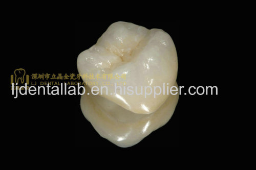 Dental crown 3M Lava zirconia & dental teeth & dental prosthesis & crown and bridge