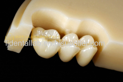 Dental crown multilayer zirconia & dental teeth & dental prosthesis & zirconia bridge