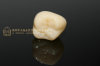 Dental crown solid zirconia crown & BruxZir crown & HT full-contour Zirconia dental crown