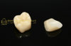 Dental crown zirconia PFZ & dental teeth & dental prosthesis & porcelain fused to zirconia crown