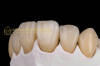 Dental crown zirconia Cercon & dental teeth & dental prosthesis