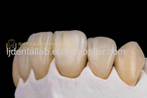 Dental crown zirconia Cercon & dental teeth & dental prosthesis