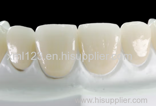 Denture e.max lithium veneer false fixed teeth of disilicate porcelain restoration artificial tooth realistic aesthetic 